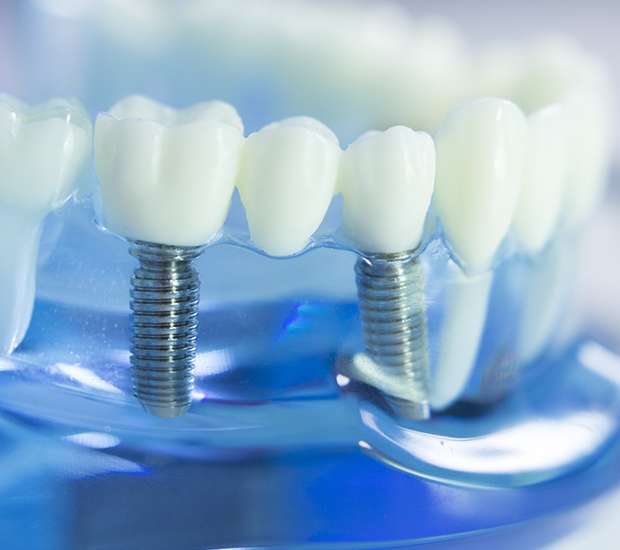 Turlock Dental Implants