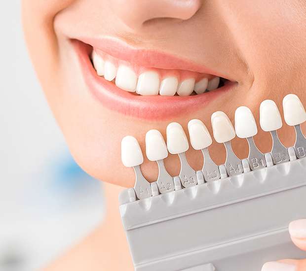 Turlock Dental Veneers and Dental Laminates