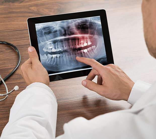 Turlock Types of Dental Root Fractures