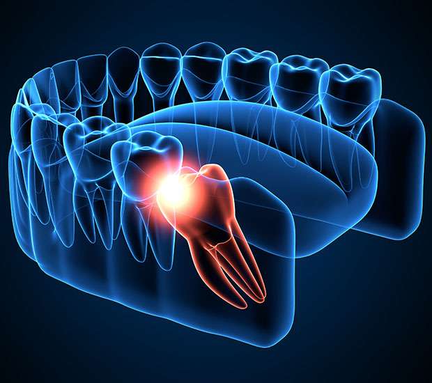 Turlock Wisdom Teeth Extraction